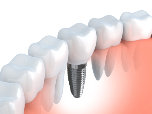 Dental implant